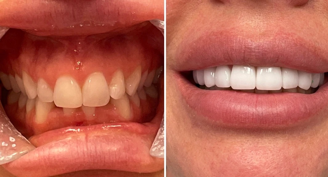Before and after cosmetic dental transformation — Glisten Dental Mesa