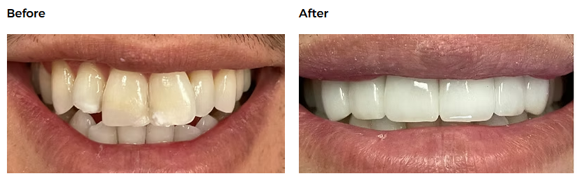 Dental implant case result — Glisten Dental Mesa
