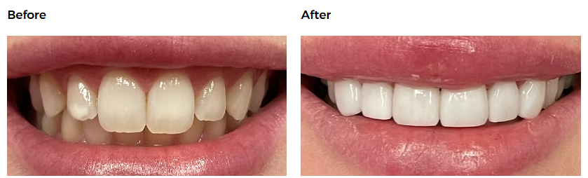 Invisalign before and after — Glisten Dental Mesa