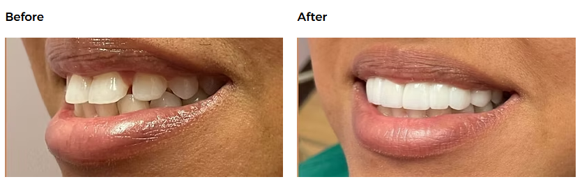 Restorative dental case — Glisten Dental Mesa
