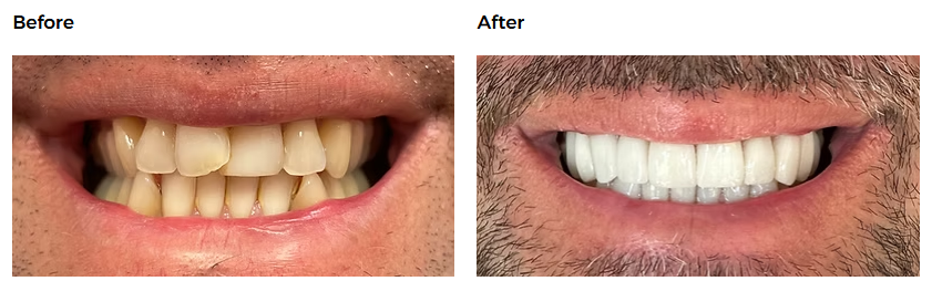 Smile makeover case — Glisten Dental Mesa