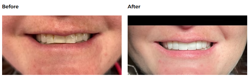 Full restoration case — Glisten Dental Mesa