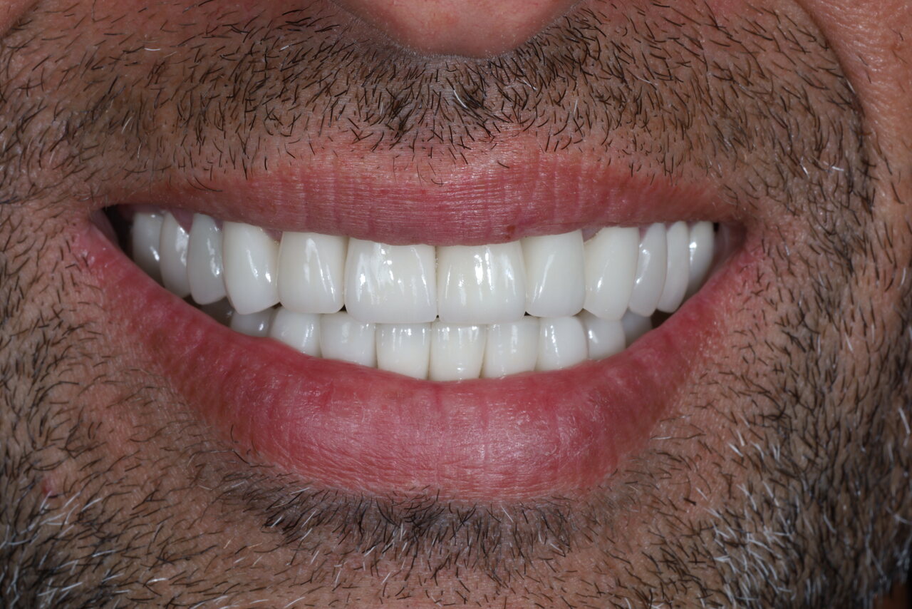 After smile transformation at Glisten Dental Mesa