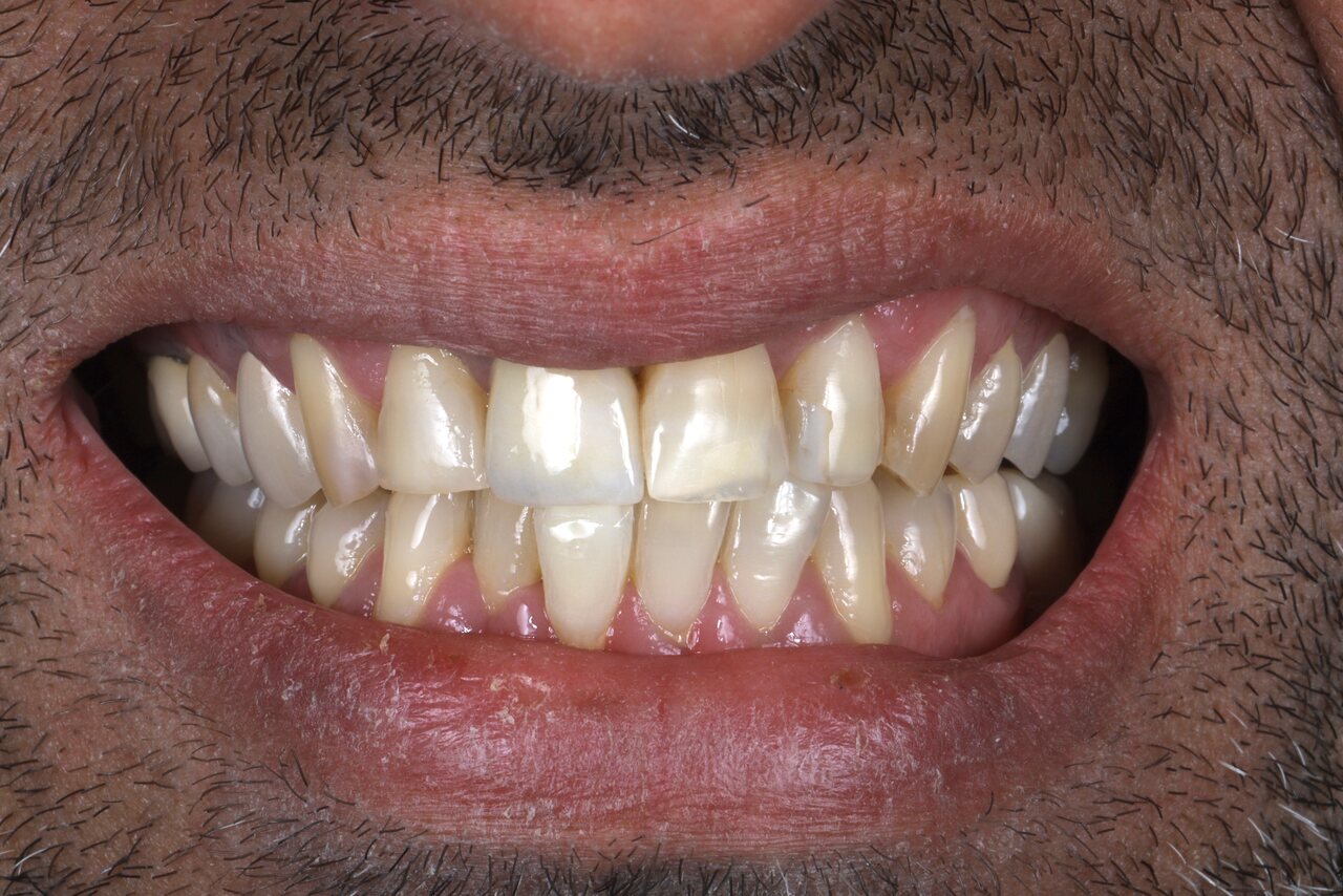 Before smile transformation at Glisten Dental Mesa