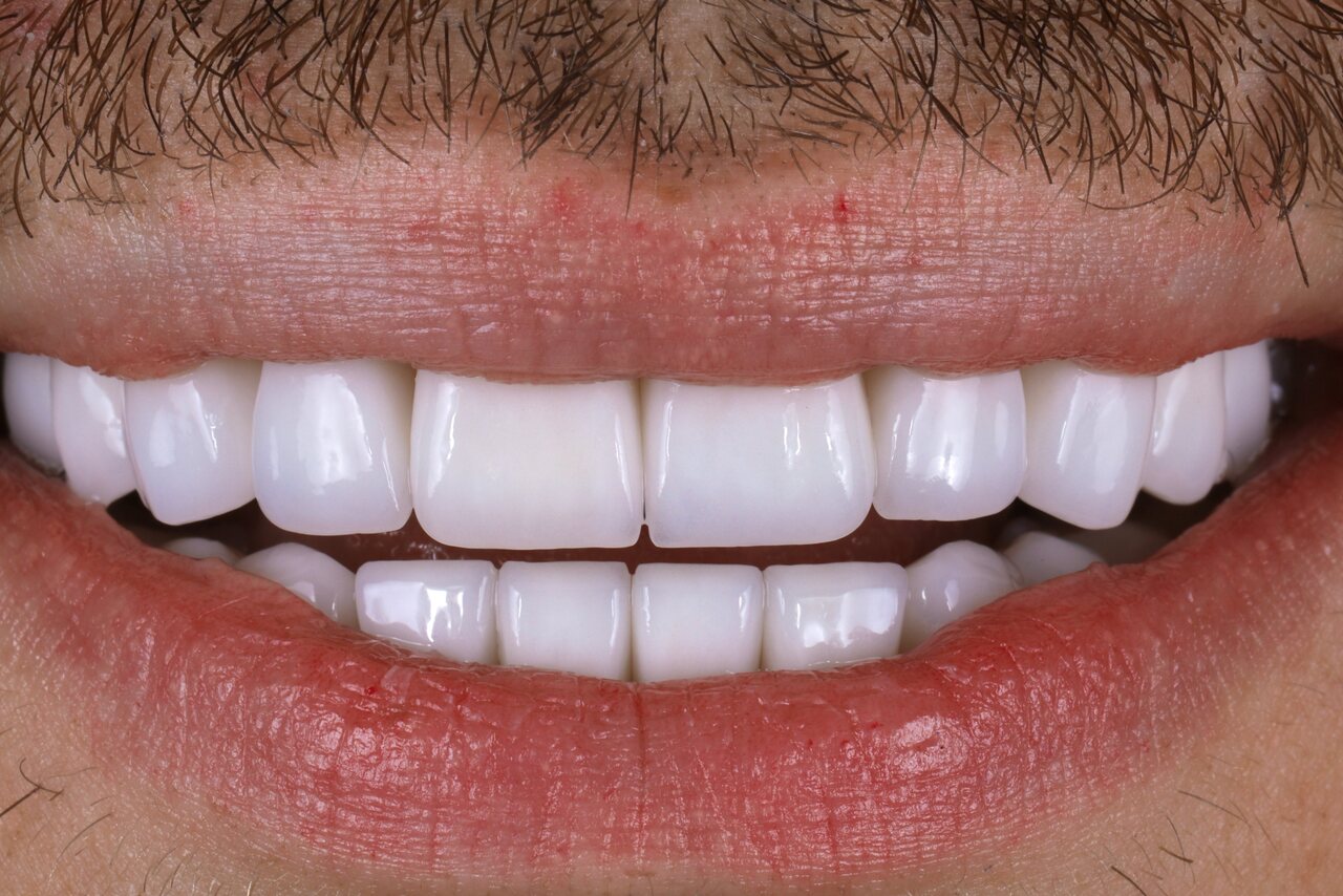 After smile transformation at Glisten Dental Mesa
