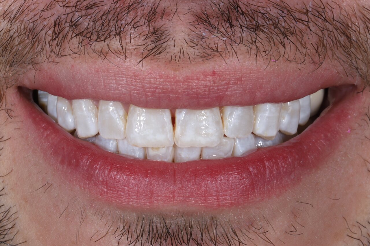 Before smile transformation at Glisten Dental Mesa