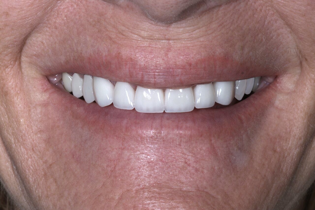 After smile transformation at Glisten Dental Mesa