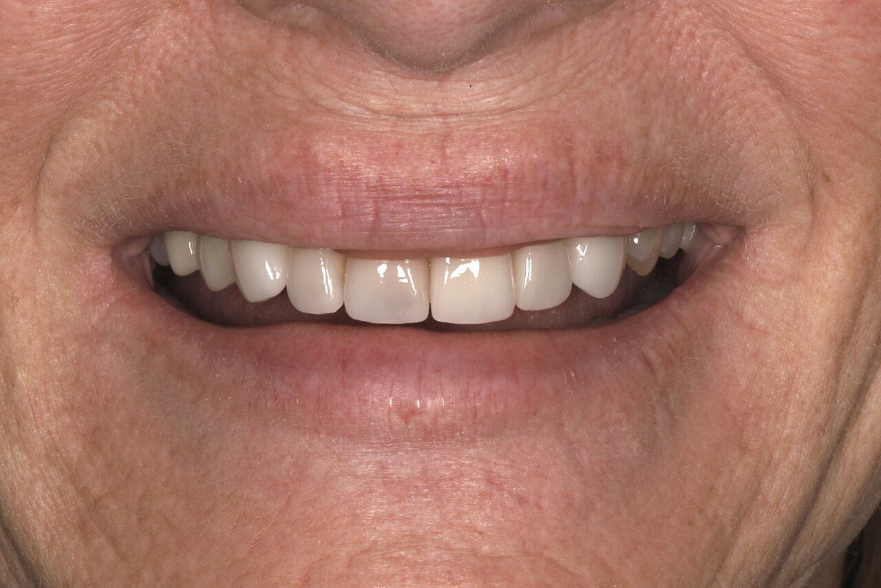 Before smile transformation at Glisten Dental Mesa