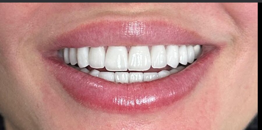 A cosmetic veneer smile result by Dr. Dawood at Glisten Dental Mesa