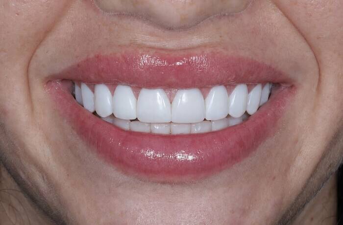 Cosmetic bonding after, Glisten Dental Mesa