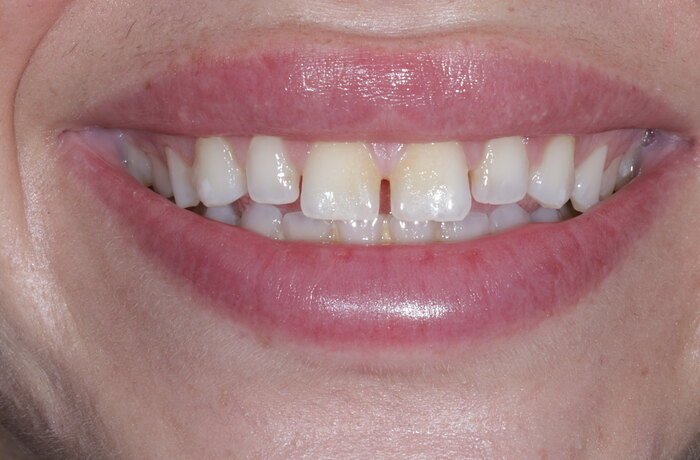 Cosmetic bonding before, Glisten Dental Mesa