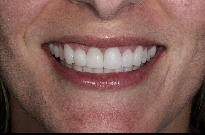 Cosmetic bonding after, Glisten Dental Mesa
