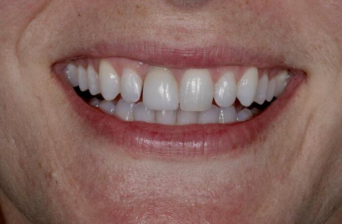 Cosmetic bonding before, Glisten Dental Mesa