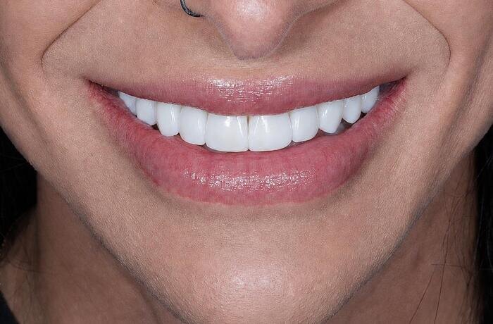 Cosmetic bonding after, Glisten Dental Mesa