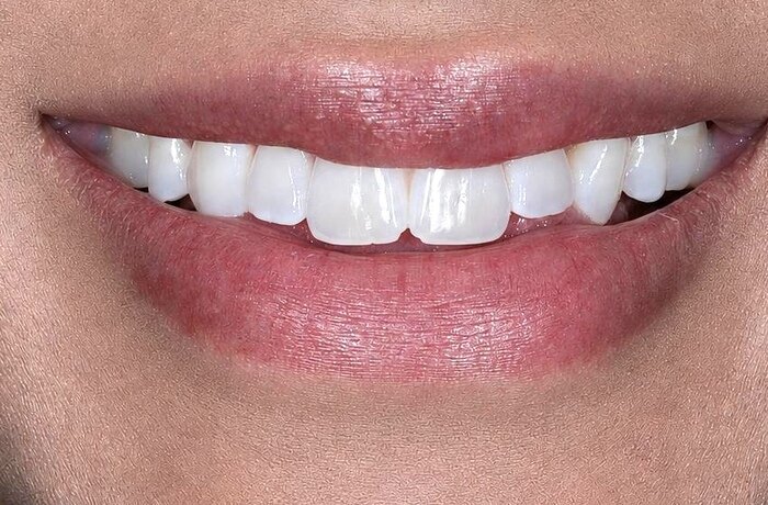 Cosmetic bonding before, Glisten Dental Mesa