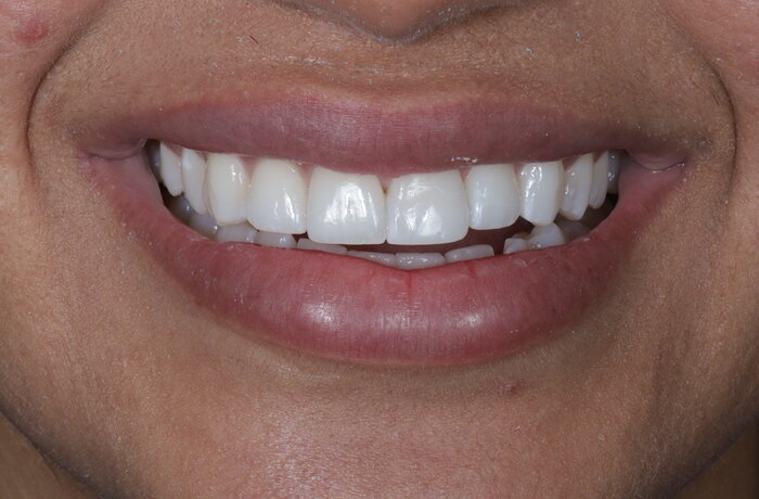 Cosmetic bonding after, Glisten Dental Mesa