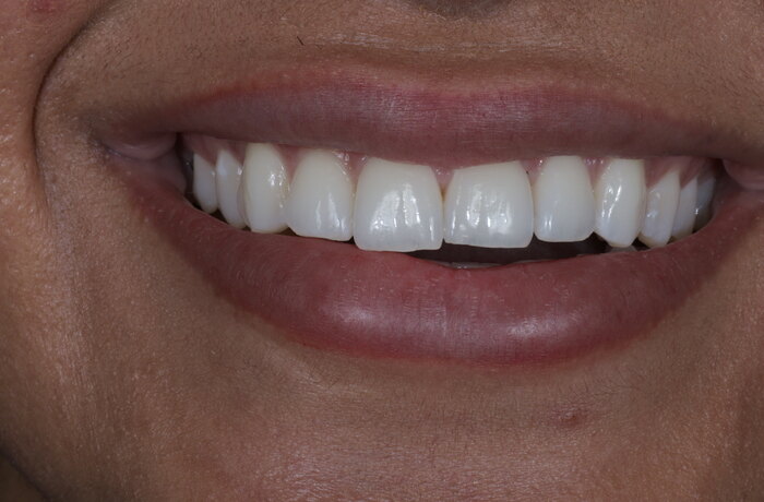 Cosmetic bonding before, Glisten Dental Mesa